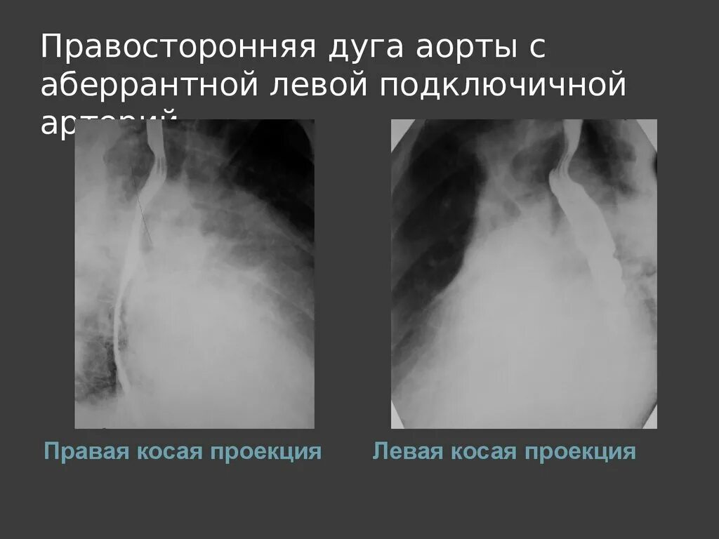 Праволежащая аорта на рентгене. Правосторонняя дуга аорты. Правосторонняя дуга аорты рентген. Аберрантная правая подключичная артерия.