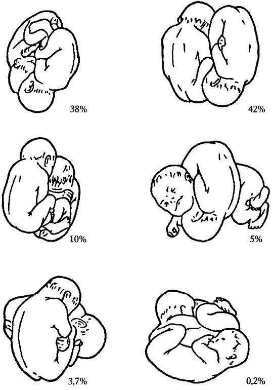 Положение плода в животе. Положение плодов при многоплодной беременности. Предлежание плодов при многоплодной беременности. Тазовое и поперечное предлежание двойни. Расположение плодов при двойне.