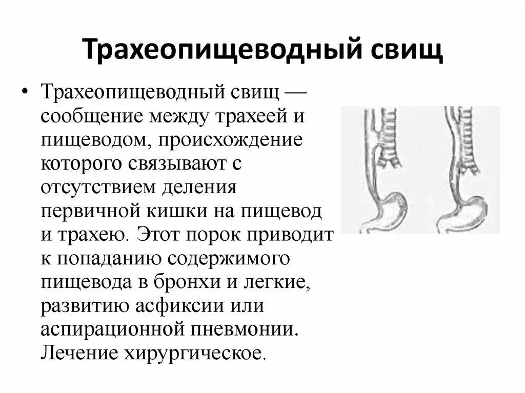 Атрезия пищевода