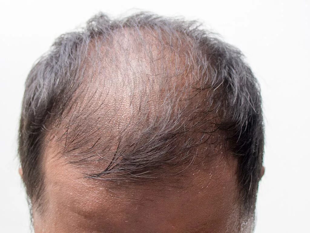 Выпадение волос головы причина лечение. Экозависимая алопеция. Андрогензависимая алопеция.