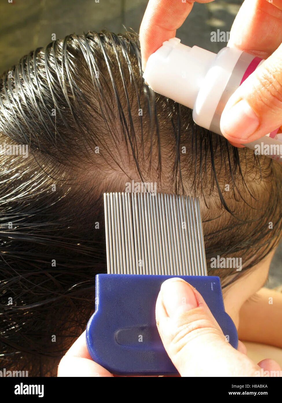 Watch: Is this the most extreme case of headlice EVER? Lice infestation, Head lo