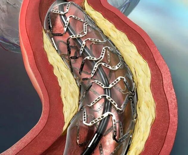 Стенты для сосудов. ТРАНСЛЮМИНАЛЬНАЯ ангиопластика сосудов. Стентирование сосудов сердца. Коронарное стентирование сосудов сердца. ТРАНСЛЮМИНАЛЬНАЯ коронарная ангиопластика.