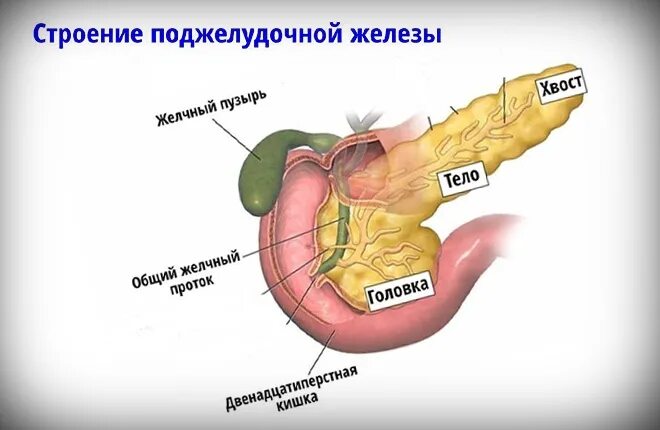 Камни в поджелудочной железе. Камни из поджелудочной железы. Камни в протоках поджелудочной железы. Камни в поджелудочной железе причины.