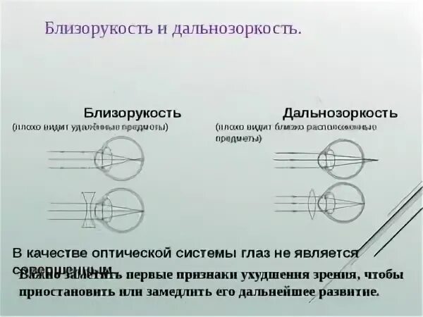 Близорукость. Близорукость или дальнозоркость. Миопия и гиперметропия. Близорукости и дальнозоркости различия. Не вижу близко это плюс или минус