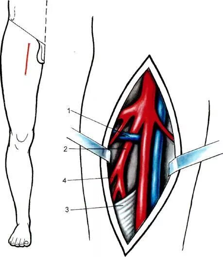 Бедренная перевязка. Доступ к бедренной артерии под паховой связкой. Оперативные доступы к подколенной артерии. Обнажение бедренной и подколенной артерии. Хирургический доступ к общей бедренной артерии.