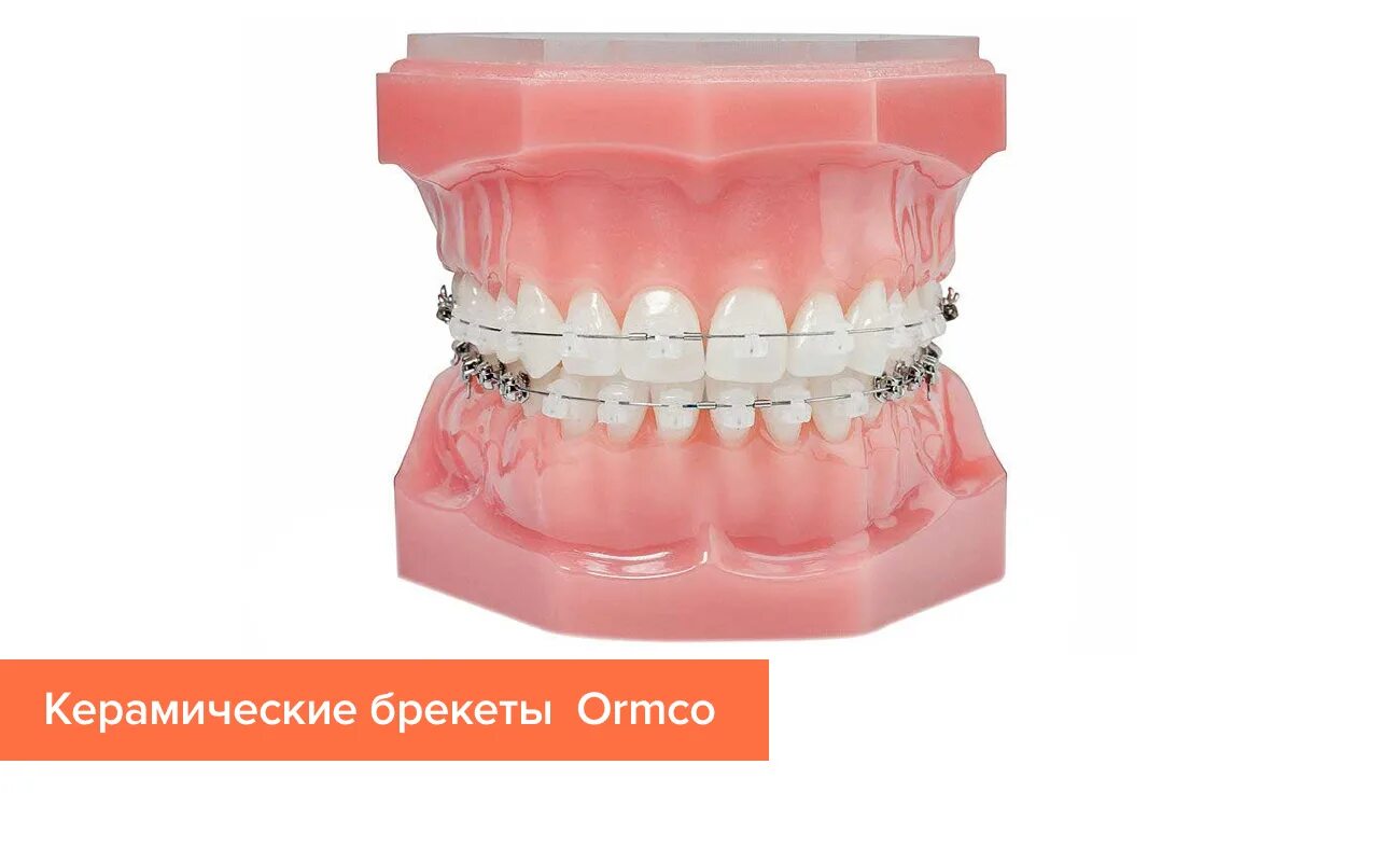 Experience система. Damon q брекеты Ormco металлические. Керамические брекеты Ormco. Экспириенс брекеты керамика.