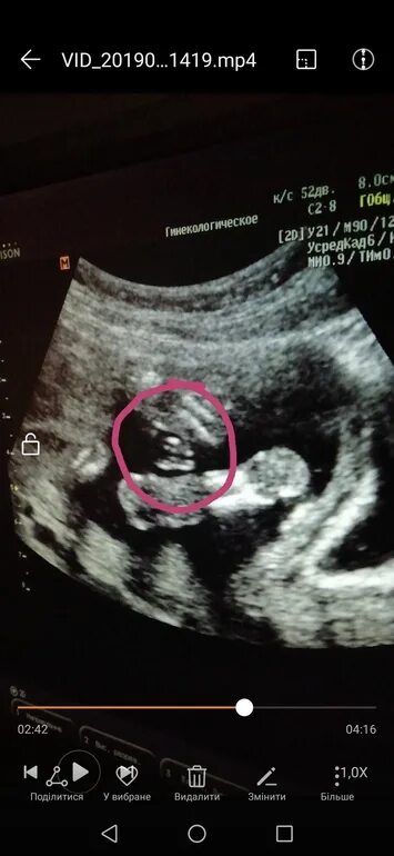 узи 19 недель девочка. узи 19 недель девочка. узи 19 недель беременности фото мальчиков. узи 19 недель беременности мальчик. узи 17 недель беременности мальчик.