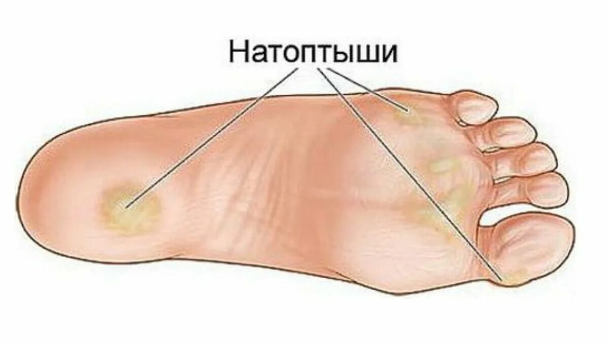 Натоптыши на подошве стопы. Как понять что у тебя трещина