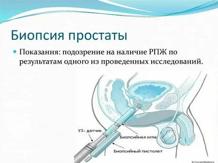 Что такое биопсия предстательной железы