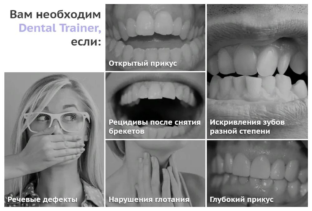 Программ капа. Трейнер для зубов до и после. Капы для открытого прикуса. Исправление глубокий прикуса трейнерами. Открытый прикус элайнерами.