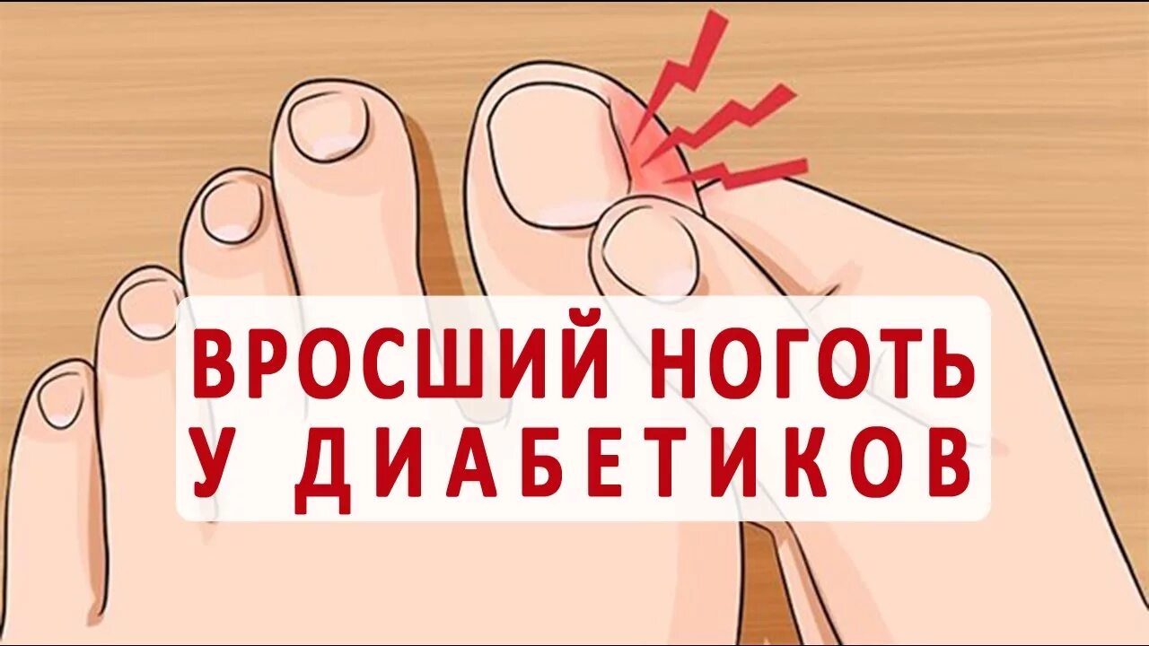В Кирове стартовала программа "Норма" для людей с сахарным диабетом: Яндекс.Ново