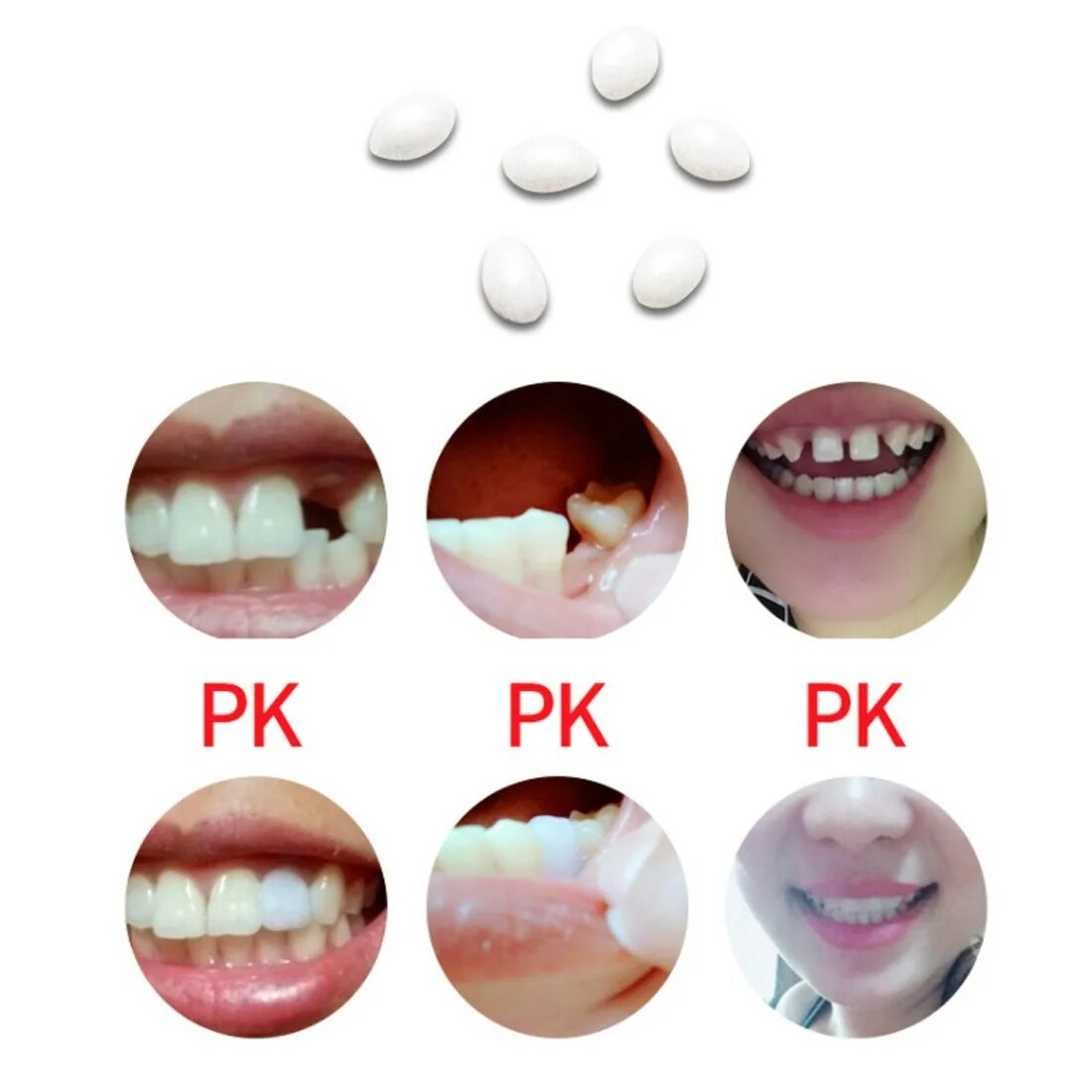 Чем можно приклеить зуб. Временный комплект для ремонта зубов. Шарики для зубов. Клей для зубов. Клей для временного ремонта зубов.