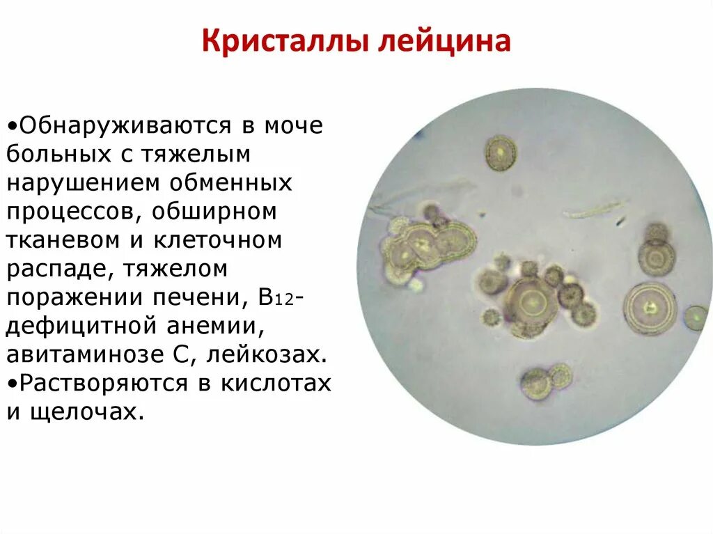 Лейцин и тирозин в моче. Кристаллы лейцина и тирозина в моче. Соли лейцин тирозин в моче. Кристаллы лейцина в моче. Кристаллы кальция в моче у мужчин