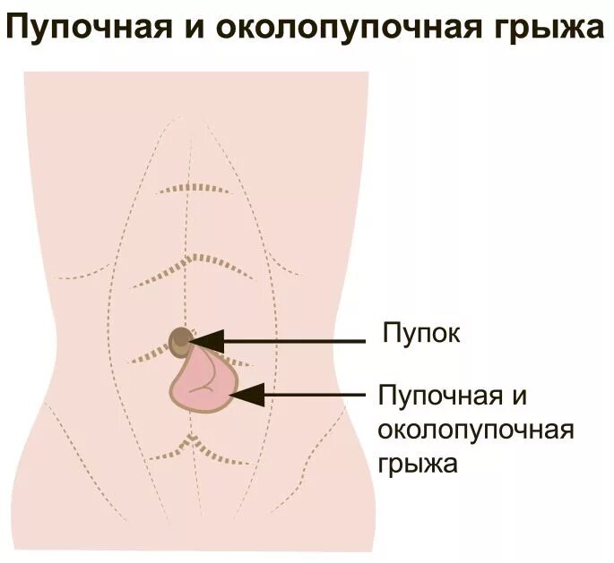 Пупочная и параумбиликальная грыжа. Параумбиликальная грыжа у детей. Параумбиликальная вентральная грыжа. Невправимая пупочная грыжа. Околопупочная область живота