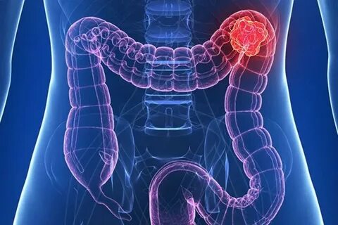 Colorectal cancer