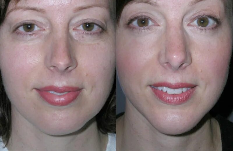 Ботокс в подбородок до и после отзывы Deep Plane Facelift Before & After Dr. Andrew Jacono Face lift surgery, Neck l