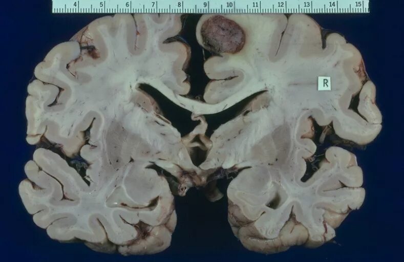 Меланома метастазы в мозг. Лептоменингеальные метастазы в головной мозг. Метастазы мозг в головном мозге. Лептоменингеальный карциноматоз. Метастазы меланомы в головной мозг.