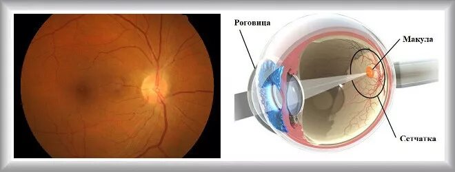 Прима макула. Макулярная дегенерация сетчатки глаза. Макулодистрофия сетчатки окт. Макула дистрофия сетчатки глаза. Возрастная дегенерация сетчатки.