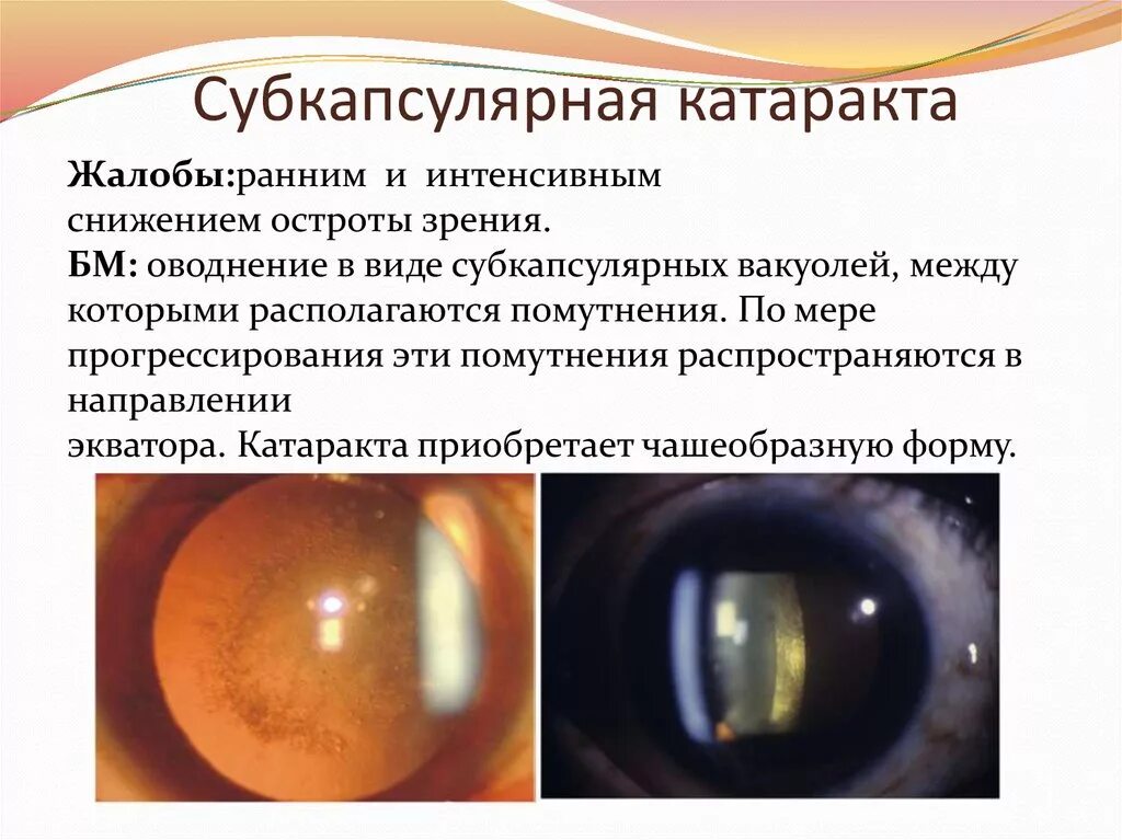 Катаракта отзывы. Ювенильная задняя субкапсулярная катаракта. катаракта биомикроскопия. врожденная заднекапсулярная катаракта. врожденная ядерная катаракта.