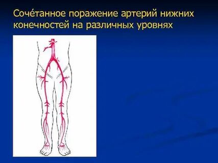 Что такое нестенозирующий атеросклероз артерий нижних конечностей