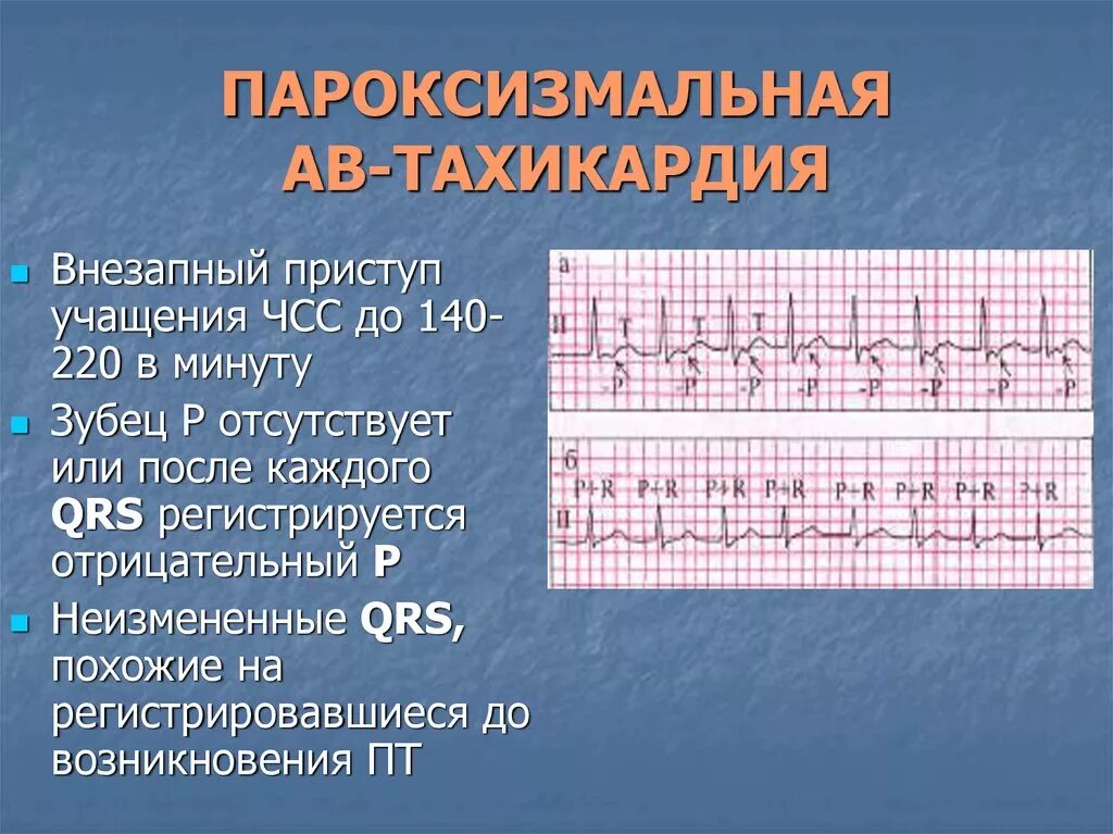 Предсердная пароксизмальная тахикардия на ЭКГ. Пароксизмальная тахикардия ЭКГ. Тахикардия на ЭКГ. Предсердная и желудочковая пароксизмальная тахикардия.