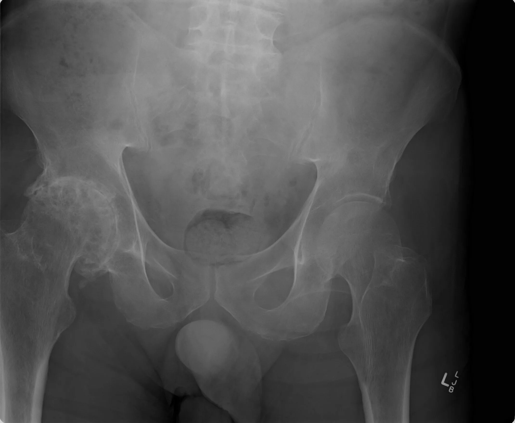 Обследование тазобедренного сустава. Symphysis pubis тазобедренного сустава. посттравматический коксартроз рентген. посттравматический коксартроз тазобедренного сустава. тазобедренный сустав анатомия коксартроз.