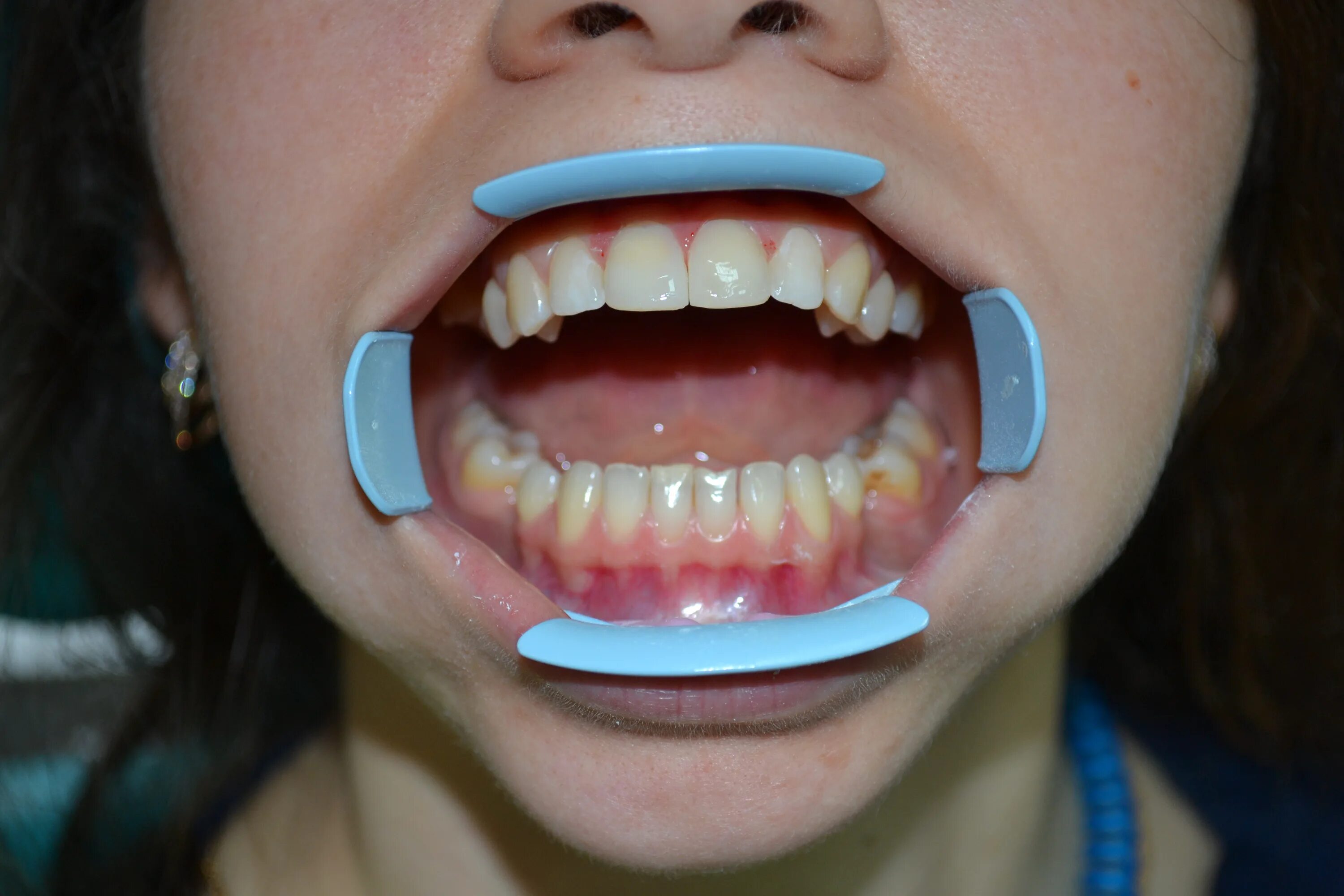 Почему зубы острые. Человек с острымиубами. Красивая мужская улыбка. Почему зубы острые. Почему зубы острые.