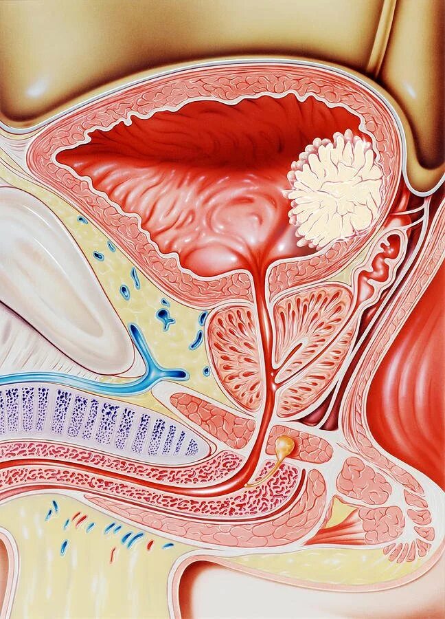 Предстательная железа, Prostata. Карцинома предстательной железы. Мочевой пузырь. Простата у мужчин. Простата это предстательная