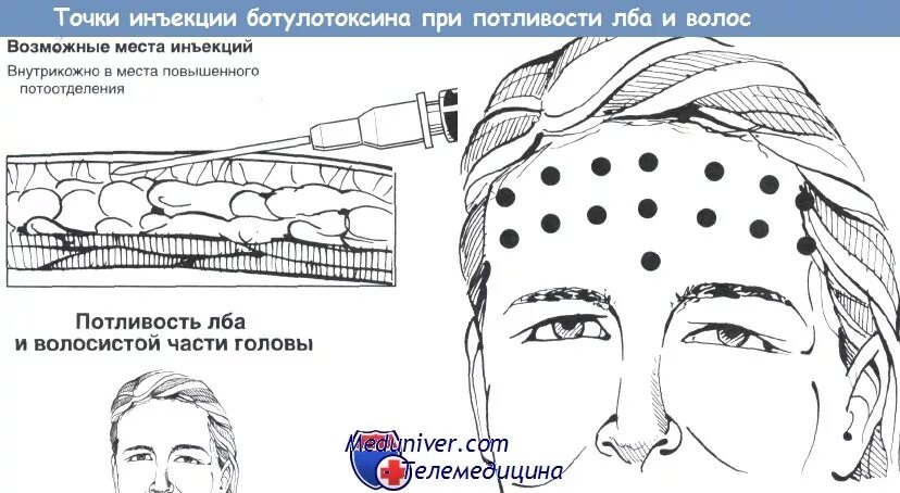 Схема ботулинотерапии. Схемы ботулинотерапии лоб. Ботулинотерапия нижней трети лица схемы. Мезотерапия головы схема. Точка уколова