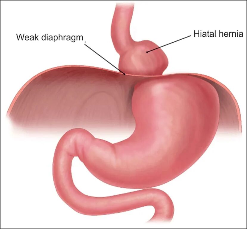 Грыжа пищеводного отверстия причины. Грыжа пищеводного отверстия диафрагмы. Пищеводная грыжа пищеводного отверстия. Грыжа пищеводного желудка. Диафрагмальная эзофагеальная грыжа.