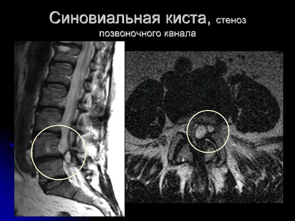 Синовиальная киста позвоночника на мрт. Синовиальная киста позвоночника l5 s1. Синовиальная киста позвоночника на кт. Стеноз позвоночного канала l5. Операция кисты позвоночника