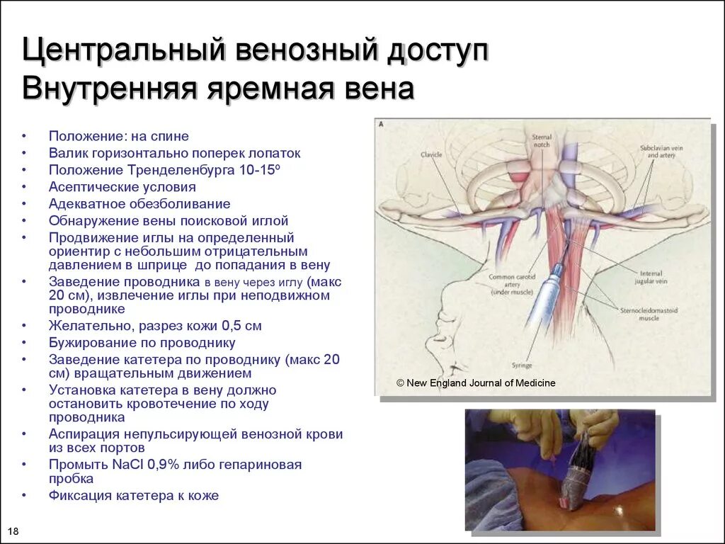 Внутренний яремный венозный катетер. Катетер во внутренней яремной вены. Техника проведения катетеризации яремной вены. Постановка периферического катетера в яремную Вену.