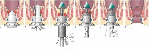 Лазерный операция геморрой сколько