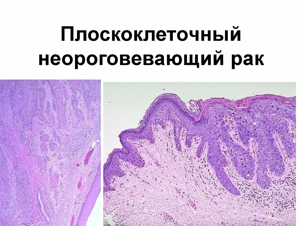 Рак матки препарат. Плоскоклеточная карцинома шейки матки гистология. Плоскоклеточная карцинома матки микропрепарат. Плоскоклеточная карцинома легкого микропрепарат. Низкодифференцированная плоскоклеточная карцинома.