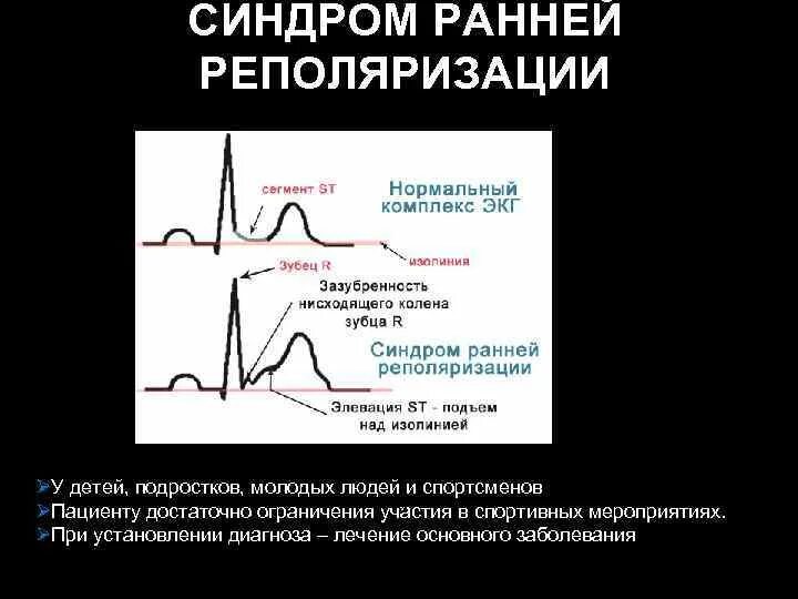 Снижение процессов реполяризации. Реполяризация миокарда желудочков экг. нарушение процессов деполяризации на экг. синдром ранней реполяризации на экг. ранняя реполяризация желудочков на экг.