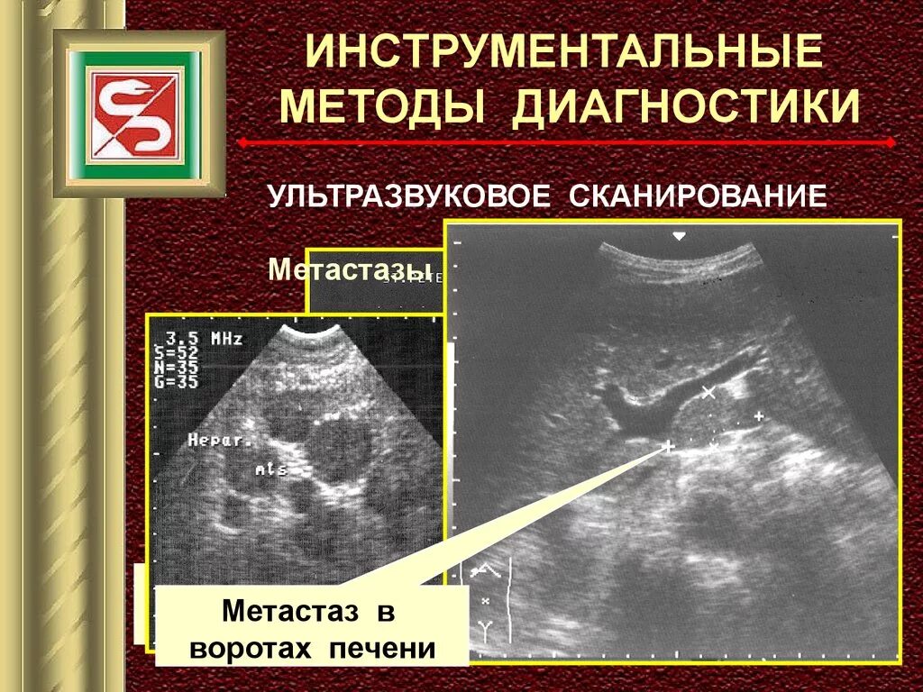 Метастатические опухоли печени. Метастатическое поражение печени. Новообразование в воротах печени. Рак метастазы в печень лечение