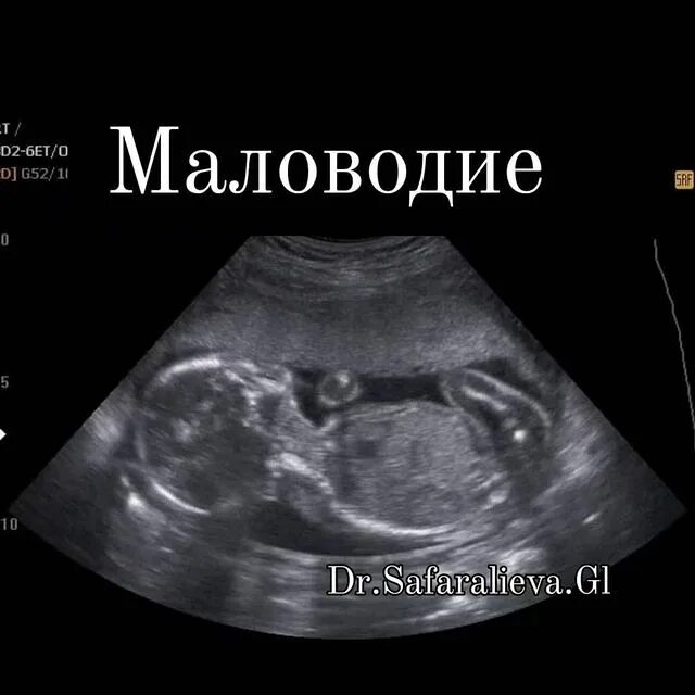 21 неделя и 4 дня. Узи плода 22 недели мальчик. узи плода 21 неделя беременности. плод на 22 неделе беременности фото узи. узи 21 неделя беременности девочка.
