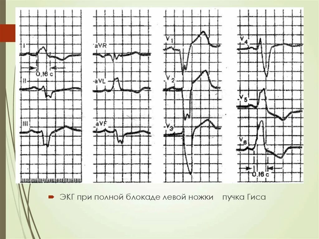 Блокада левой ножки п гиса. Блокада левой ножки пучка Гиса на ЭКГ. Блокада ножки пучка Гиса на ЭКГ. Блокада ножек пучка Гиса на ЭКГ. Полная блокада левой ножки пучка Гиса на ЭКГ.