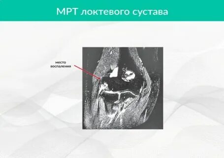 Мрт локтевого сустава