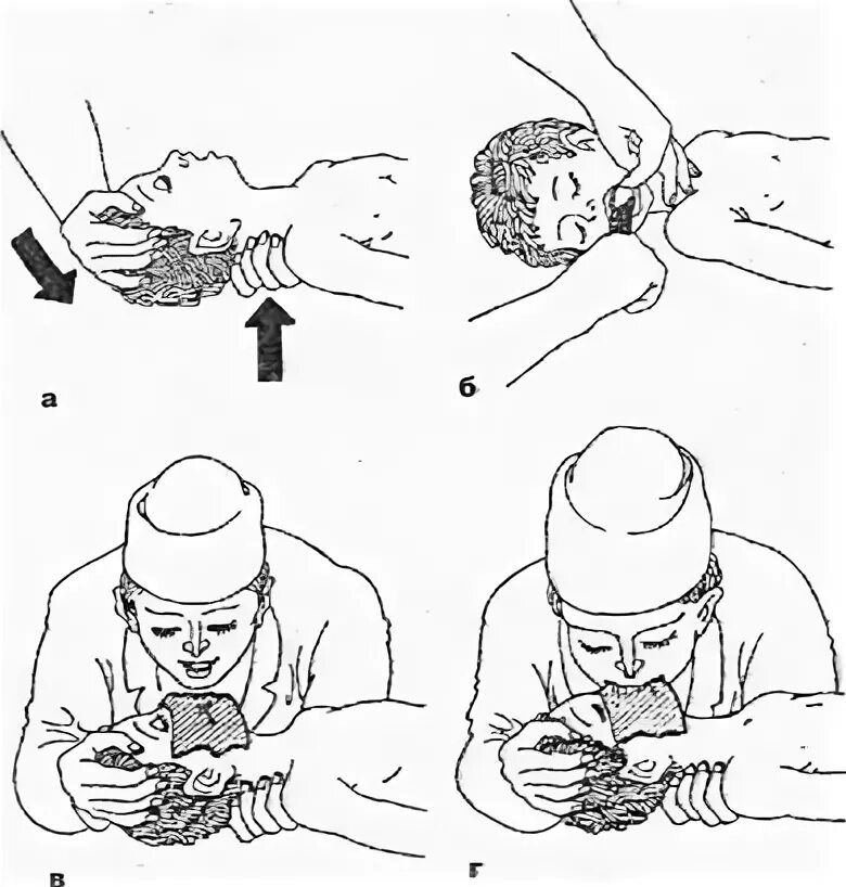 Проведение ИВЛ ребенку различными методами:. Техника искусственного дыхания ребёнку старше 1 года. Проведение искусственного дыхания ребенку до года. При проведении искусственного дыхания ребенку до года.