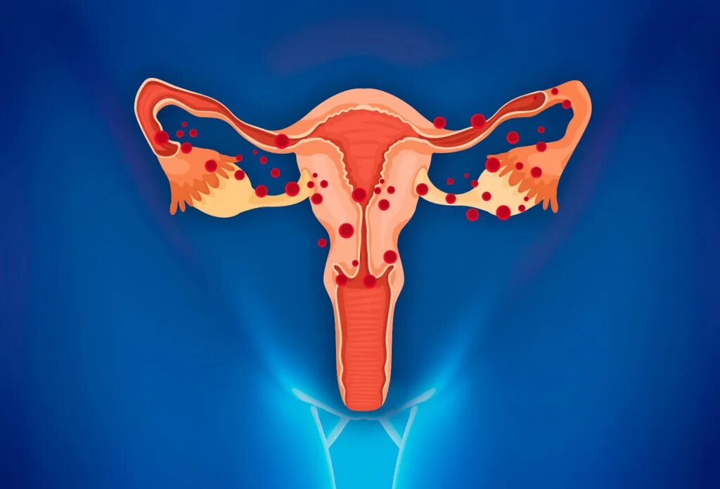 Эндометриоз макропрепарат. Овариальный эндометриоз.