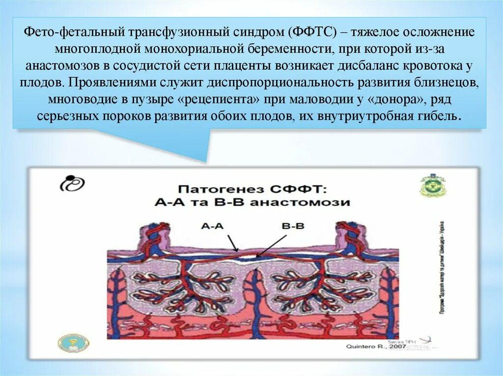 Синдром донора. Фето фетальный трансфузионный синдром. Синдром фетоплацентарной трансфузии. Синдром фетальной трансфузии при многоплодной беременности. Осложнения фето-фетальной трансфузии.