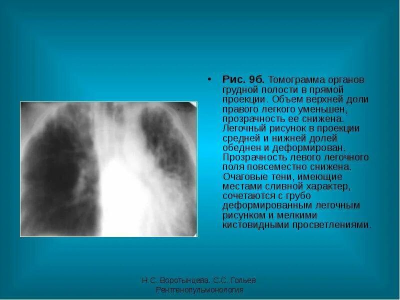 Рак нижней доли. Томограмма легких в прямой проекции. Снижение прозрачности легких что это. Снижение прозрачности в средней и нижней доле правого легкого.