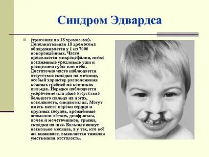 Кариотип больного с синдромом эдвардса