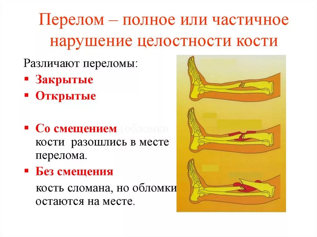 Виды переломов и первая помощь при них. Переломы костей определение виды признаки первая помощь. Переломы по степени нарушения целостности кости. Перелом кости - частичное или полное нарушение целостности кости.