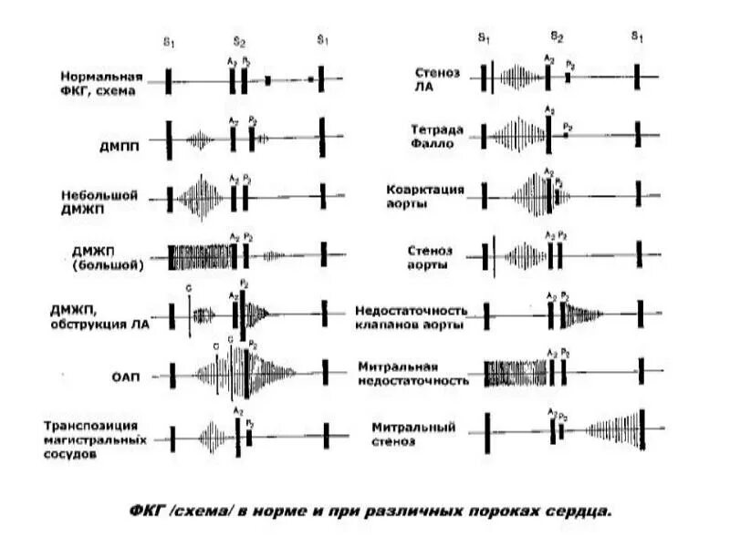 Графическое изображение фкг. Фонокардиограмма при недостаточности митрального клапана. фонокардиограмма при стенозе митрального клапана. фкг при недостаточности митрального клапана. фонокардиограмма при митральной недостаточности.