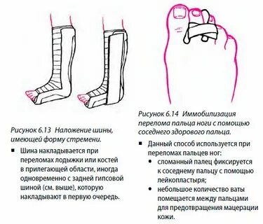 Сколько ходят с переломом