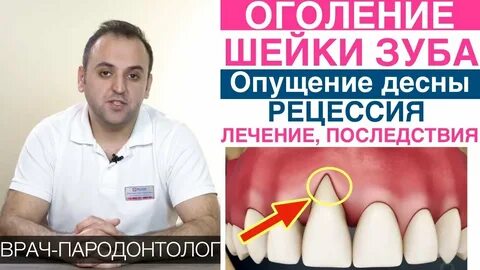После лечения зуба десны