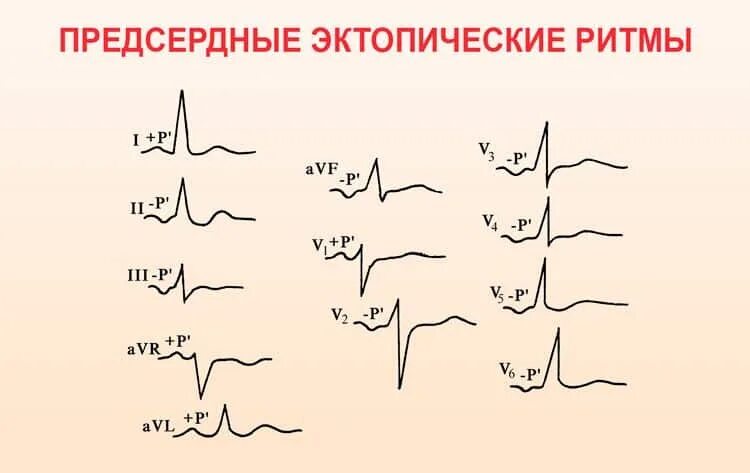 Эктопический ритм у ребенка. Эктопический предсердный ритм на экг. эктопический нижнепредсердный ритм на экг. предсердный ритм сердца на экг. экг при нижнепредсердном ритме.