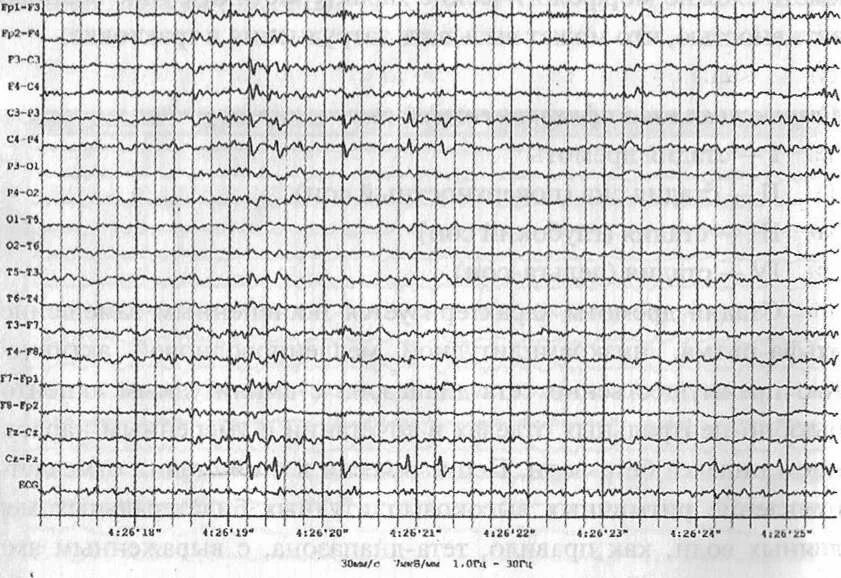 Потенциал ээг. Вертексные волны на ЭЭГ. Вертексные потенциалы на ЭЭГ. Вертекс потенциалы на ЭЭГ. Эпилептиформная активность на ЭЭГ.